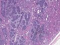Part of whole slide image of a Wilms' tumor of the kidney
