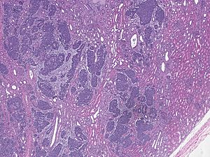 Part of whole slide image of a Wilms' tumor of the kidney
