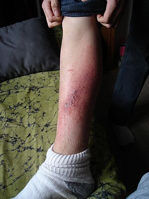 Poison ivy rash