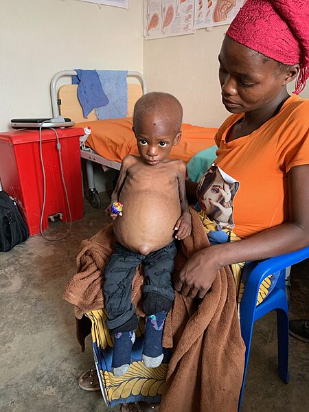 Protein malnutrition