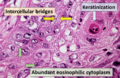 Histopathology of squamous-cell carcinoma