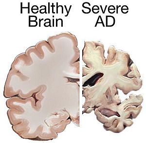 Alzheimers brain