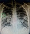 Pulmonary metastases shown on Chest X-Ray 