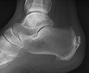 Achilles insertional calcific tendinosis