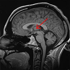 Brain chrischan thalamus
