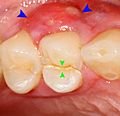 Cracked tooth lateral periodontal abscess