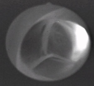 Aortic valve