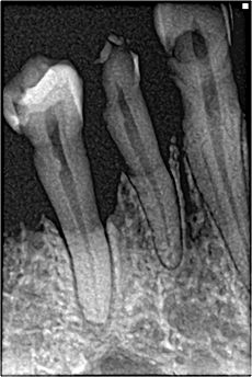 Bone loss in periapical xray