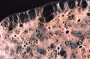 Emphysema, bullous, subpleural and honeycomb fibrosis (4563270966)