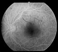 Retinal branch occlusion ratkaj