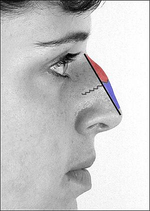 RhinoplastyProfileHump