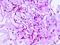 Esophageal candidiasis (2) PAS stain