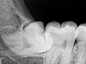 Impacted Wisdom Tooth aka Lower Right Third Molar 48 RVG IOPA Xray
