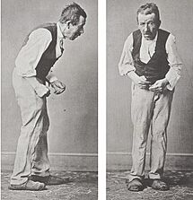 Side and front views of a Parkinson's patient, illustrating hunched posture