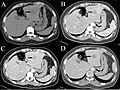 Triphasic CT scan of hepatocellular carcinoma