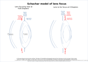Schachar model of focus