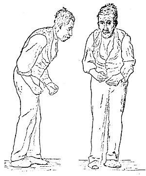 Sir William Richard Gowers Parkinson Disease sketch 1886