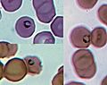 Malarial parasites, Plasmodium species, ring forms in red blood cells