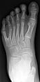 Polydactyly 01 Lfoot AP