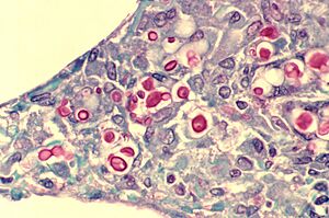Cryptococcosis of lung in patient with AIDS. Mucicarmine stain 962 lores