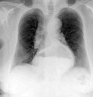 Radiografía pulmones Francisca Lorca.cropped