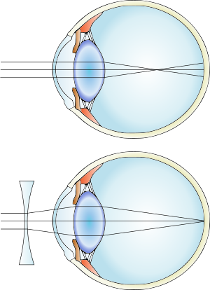 Myopia and lens correction