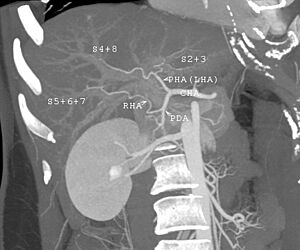 CT scan showing liver and kidney