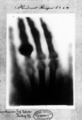 First medical X-ray by Wilhelm Röntgen of his wife Anna Bertha Ludwig's hand - 18951222