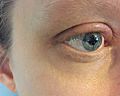 Swollen Eyelid Due to Allergy (48140096766)