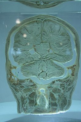 Cross-section of brain prepared by William Macewen, c.1900, Hunterian Museum