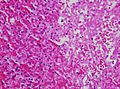 Histopathology of cytoplasmic hypereosinophilia in a pituitary adenoma
