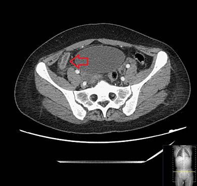 Appendicitis (CT angiogram) (Radiopaedia 154713-127660 Axial 1)