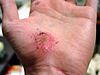 Hand Abrasion - 2 days 22 hours 12 minutes after injury.JPG