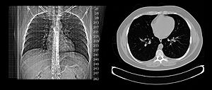 Axial plane CT scan of the thorax illustrative image