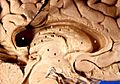 Human brain left dissected midsagittal view description 2