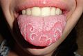 Geographic tongue (cropped)