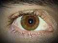 Pronounced Central Heterochromia - Human Eye