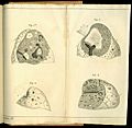 Rene-Theophile-Hyacinthe Laennec (1781-1826) Drawings diseased lungs