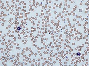 Iron deficiency anemia blood film