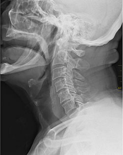 Medical X-Ray imaging EJE04 nevit.jpg