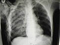 Pulmonary contusion