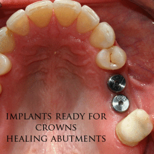 Dental-implant