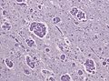 Globoid cell leukodystrophy PAS
