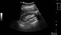 Right kidney seen on abdominal ultrasound