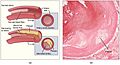 2113ab Atherosclerosis