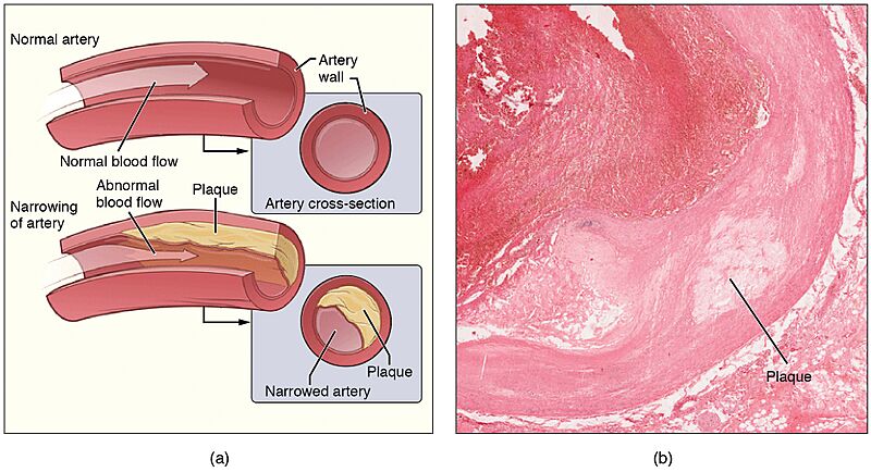 2113ab Atherosclerosis
