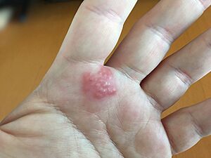 Contact dermatitis