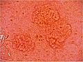 High dynamic range dermoscopy of sebaceous hyperplasia