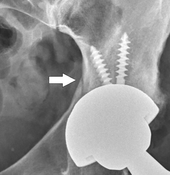 Image Intraoperative Acetabular Fracture Annotated