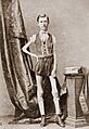 Isaac W Sprague, living skeleton, 1867